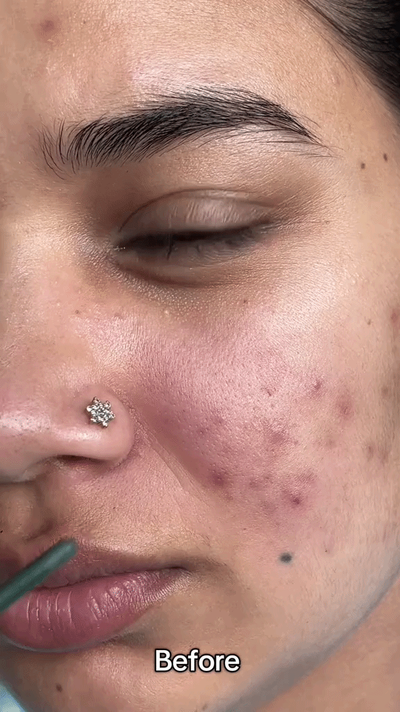 Пред третман